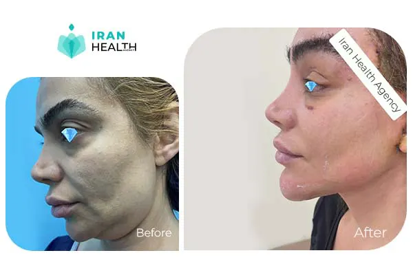 Facelift before and after 2