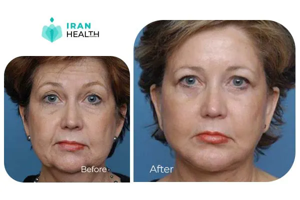 Facelift before and after 4