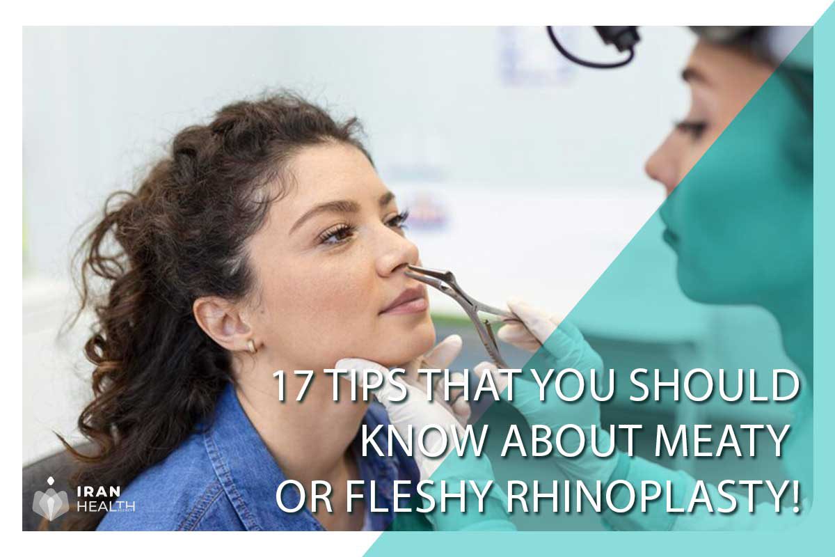 17 Tips that you should Know About Meaty or Fleshy Rhinoplasty!