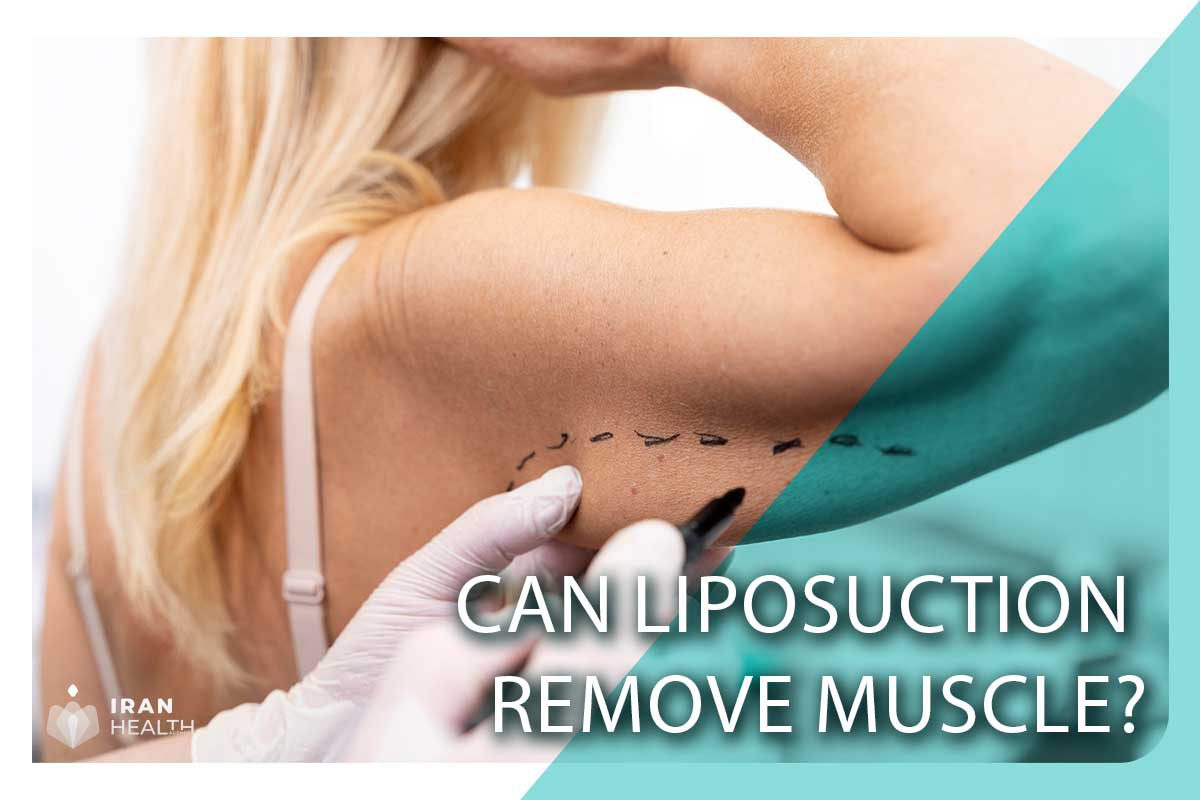 Can Liposuction remove muscle?