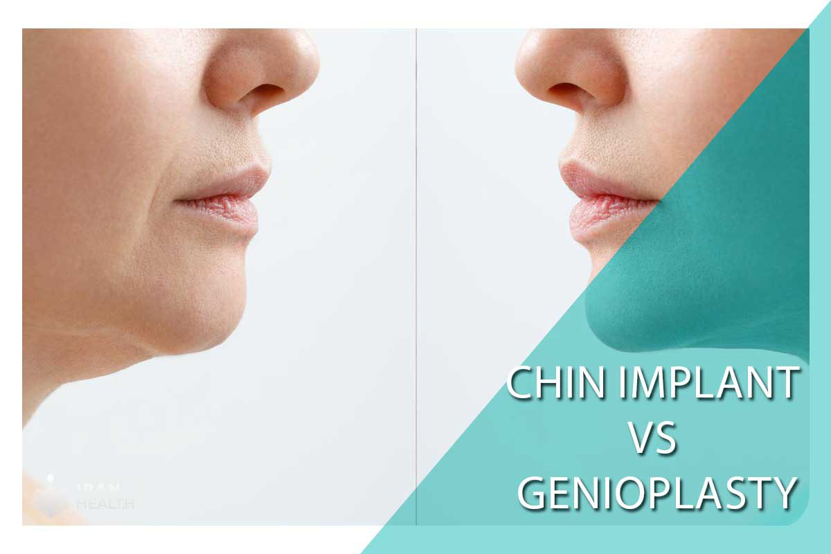 Chin implant vs Genioplasty