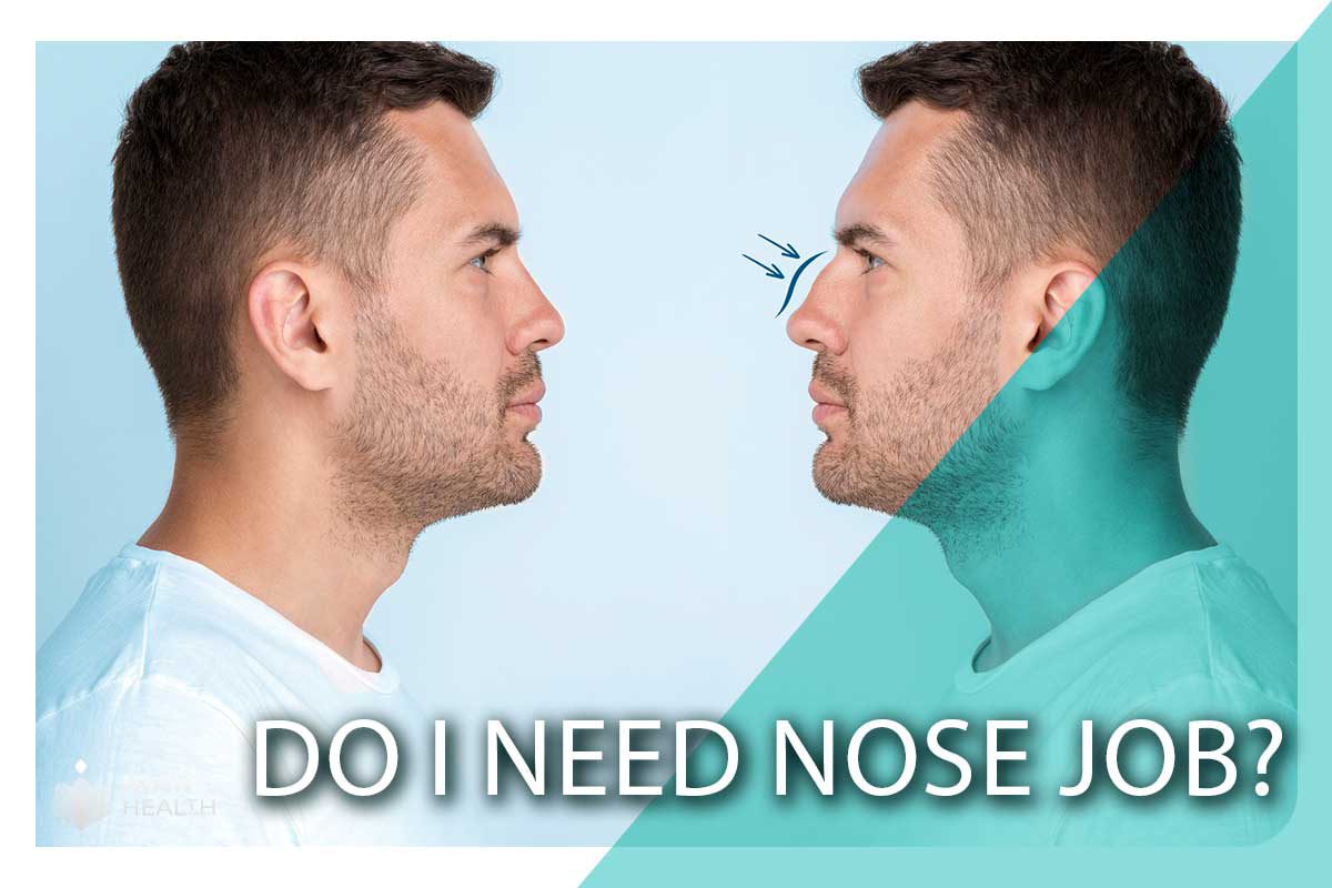 Do I need nose job?
