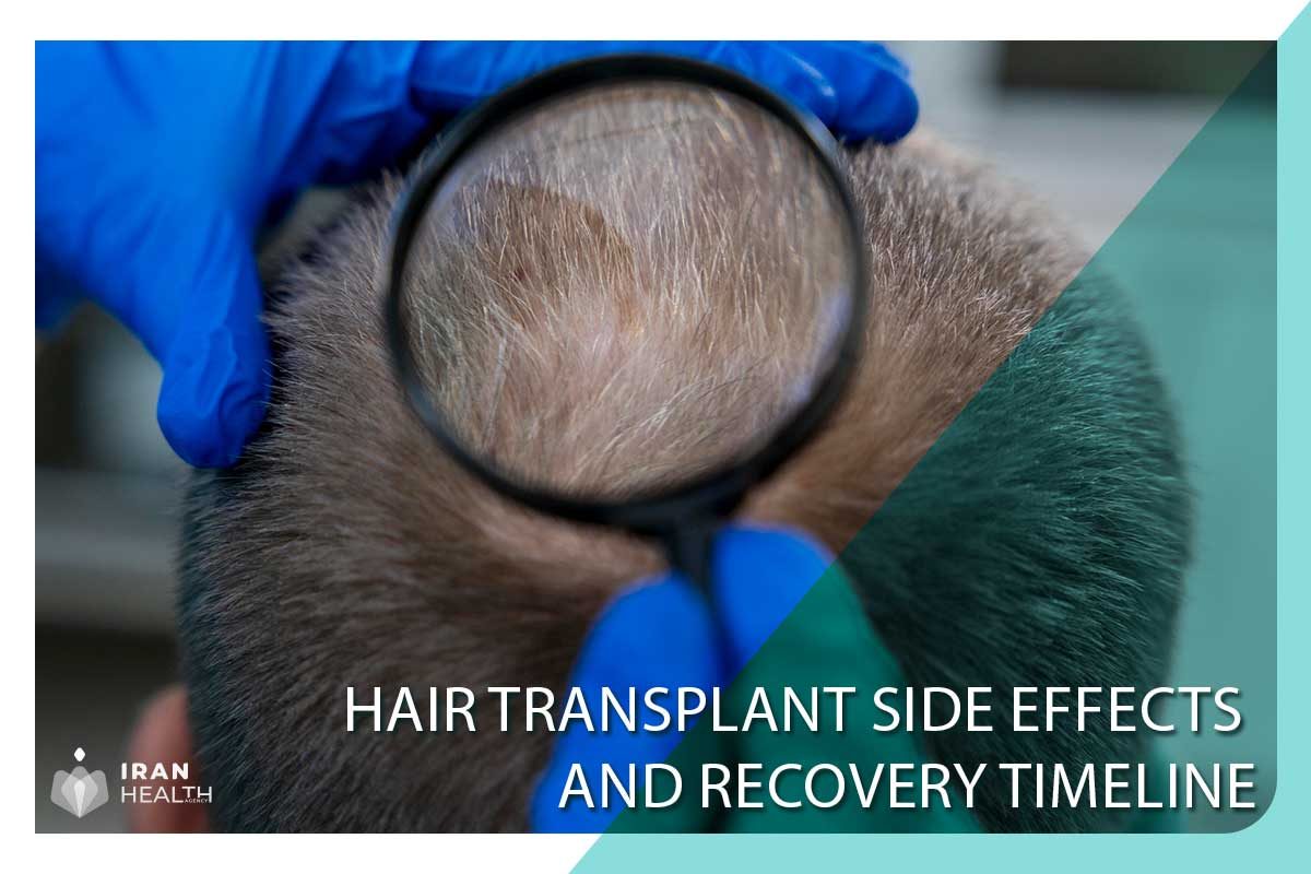 Hair Transplant Side Effects and Recovery Timeline