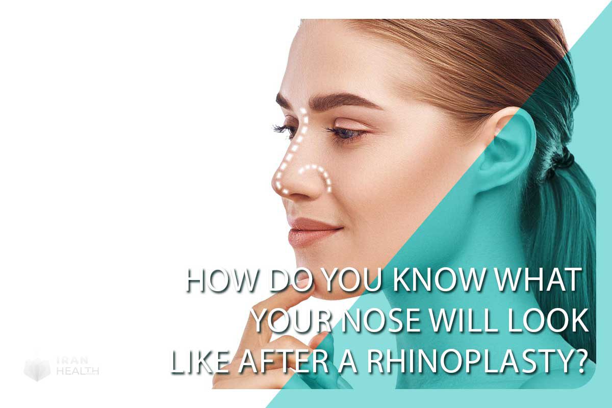 How do you know what your nose will look like after a rhinoplasty?