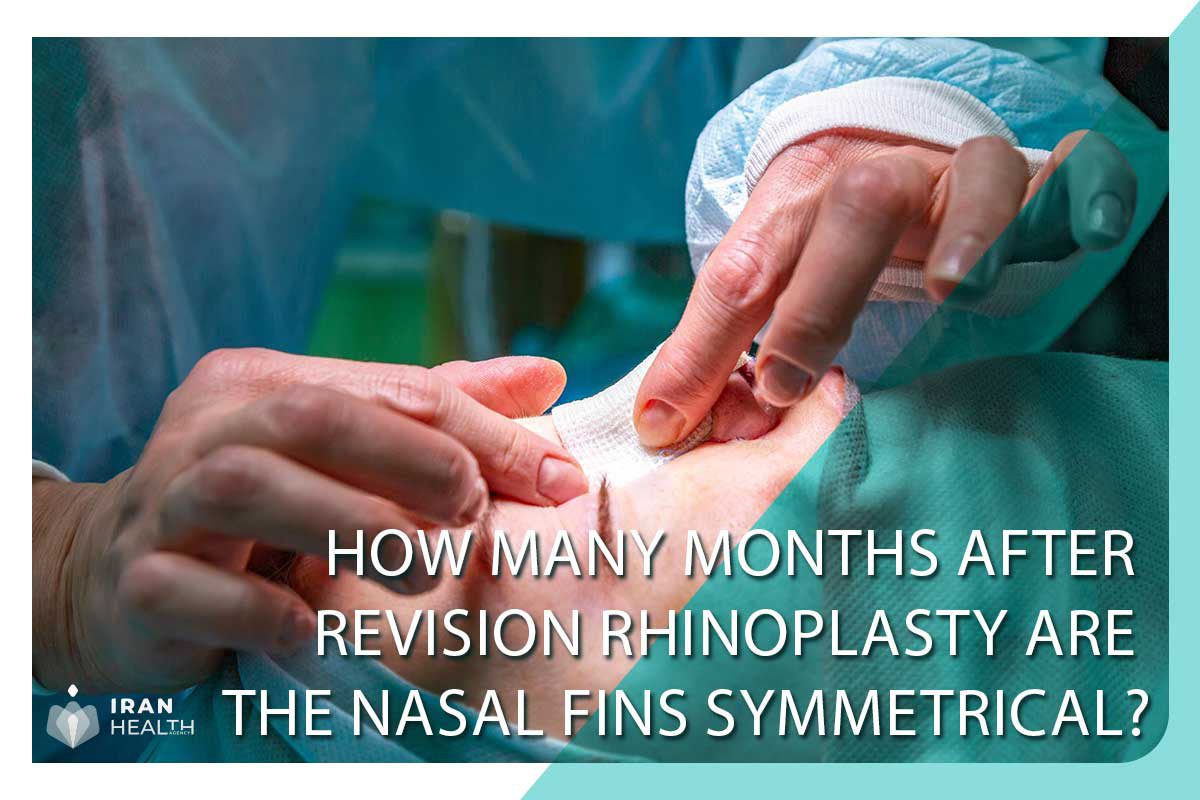 How many months after revision rhinoplasty are the nasal fins symmetrical?