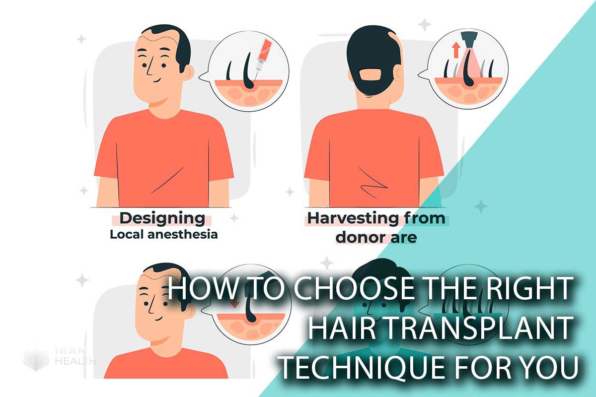 How to Choose the Right Hair Transplant Technique for You