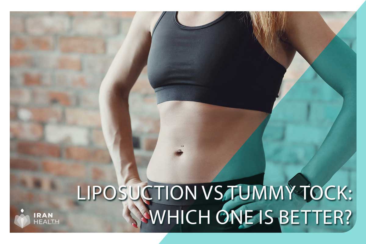 Liposuction vs Tummy tock: which one is better? 