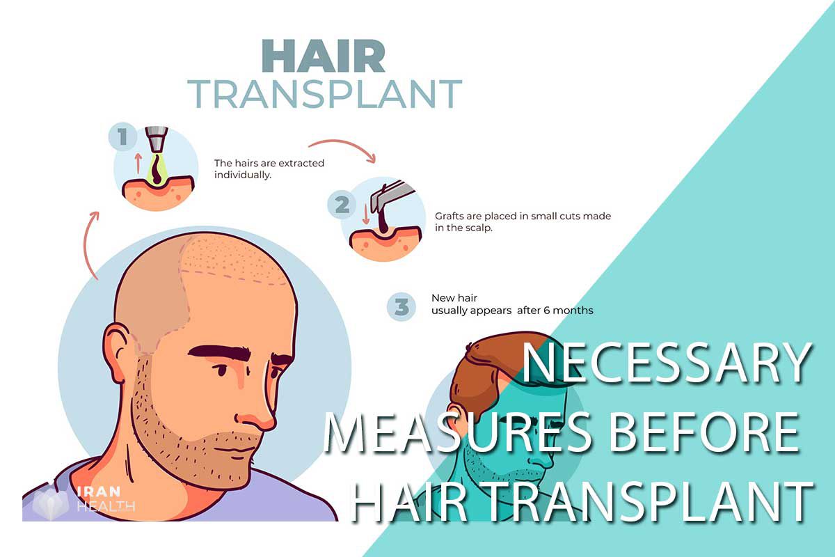 Necessary measures before Hair transplant