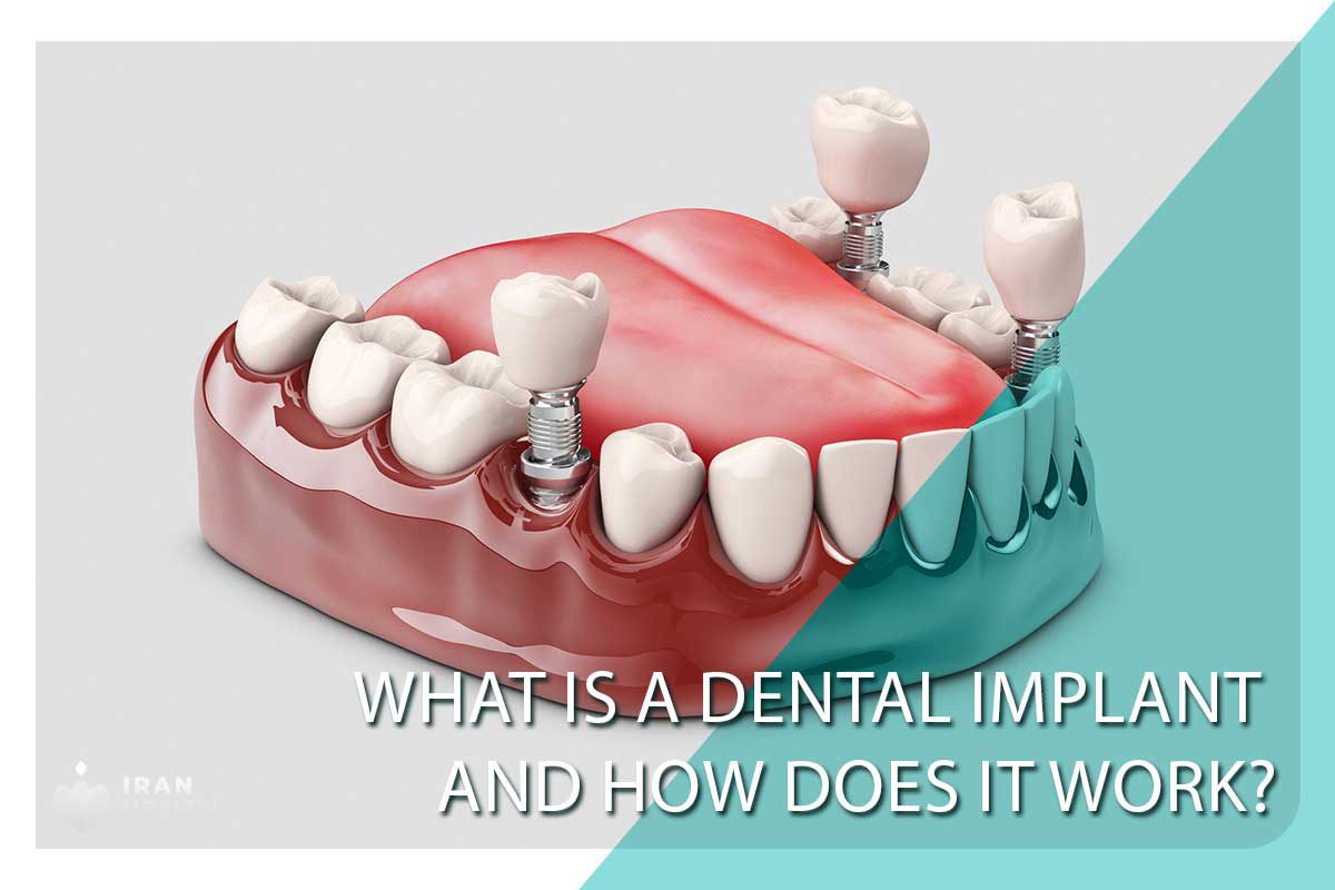 What is a Dental Implant and How Does it Work?