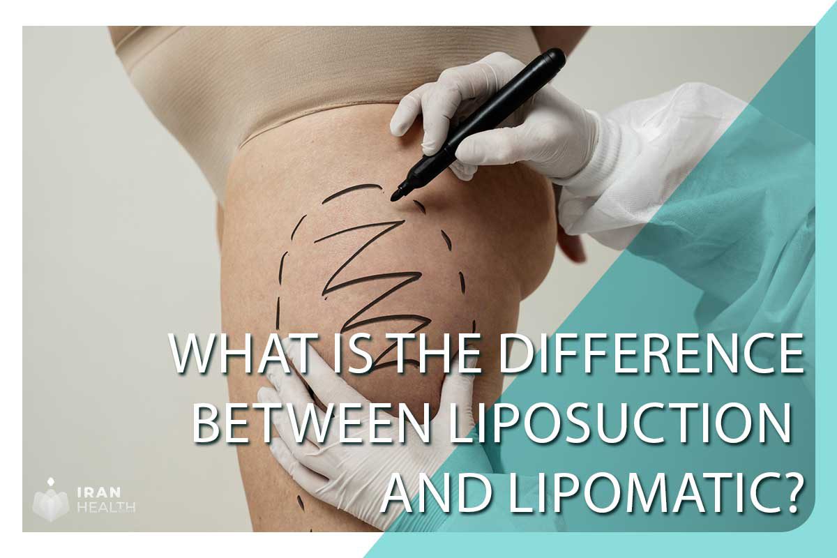 What is the difference between liposuction and Lipomatic?
