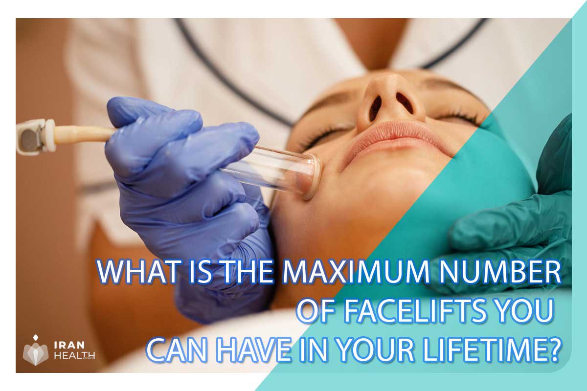 What is the maximum number of facelifts you can have in your lifetime?