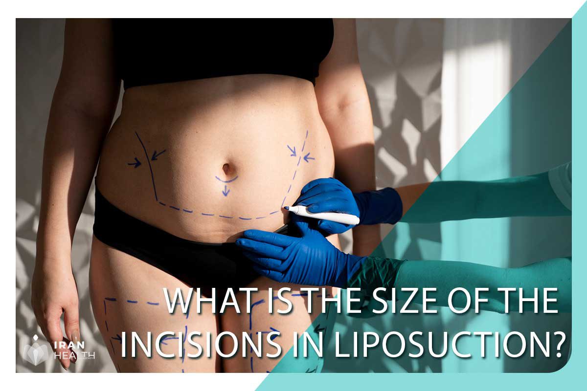 What is the size of the incisions in liposuction?