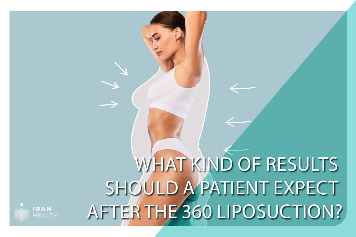 What kind of results should a patient expect after the 360 liposuction?