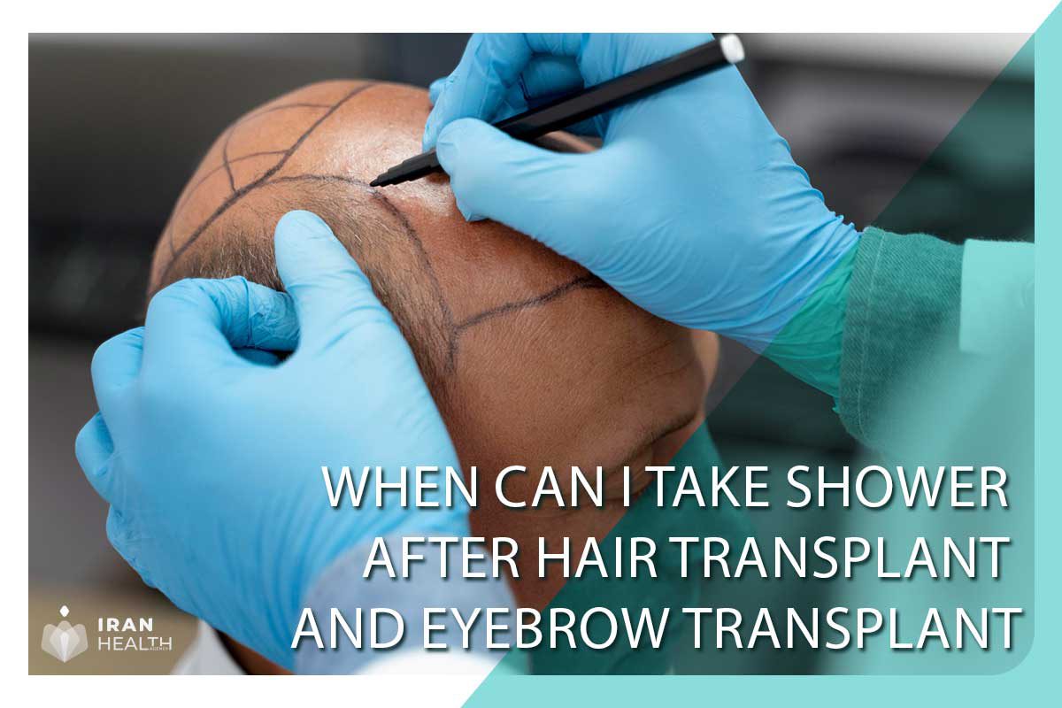 When can I take shower after hair transplant and eyebrow transplant